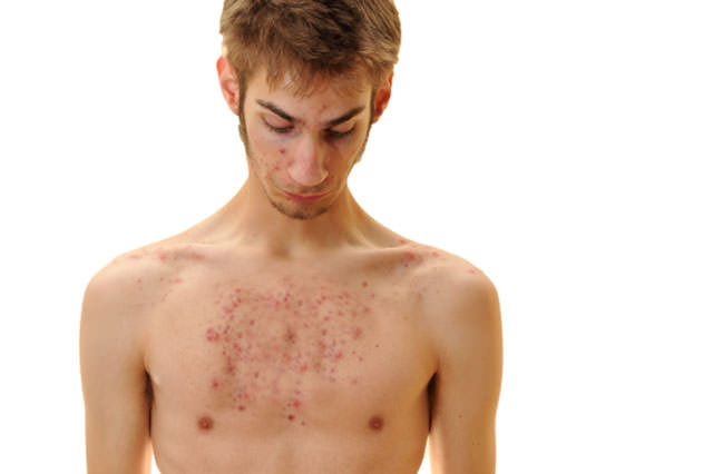 Young teenager looking down at his chest with acne
