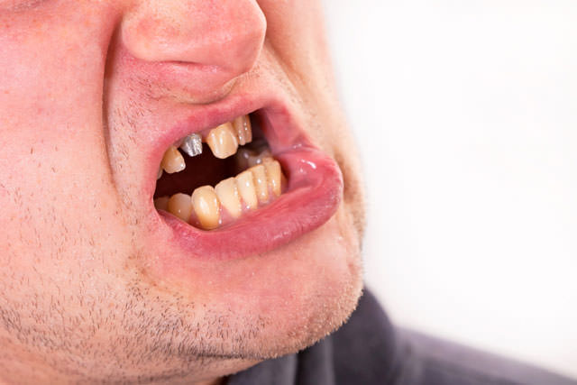 Young man face with broken tooth